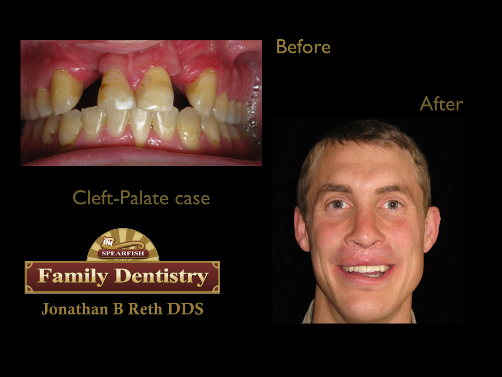 This gentleman was born with a cleft-palate/lip and wore a retainer his whole life. 