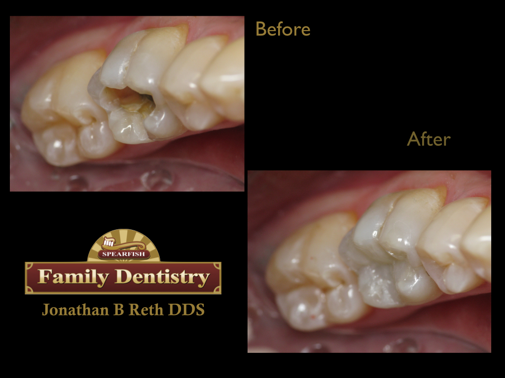 Direct resin composite fillings in less than 1 hour