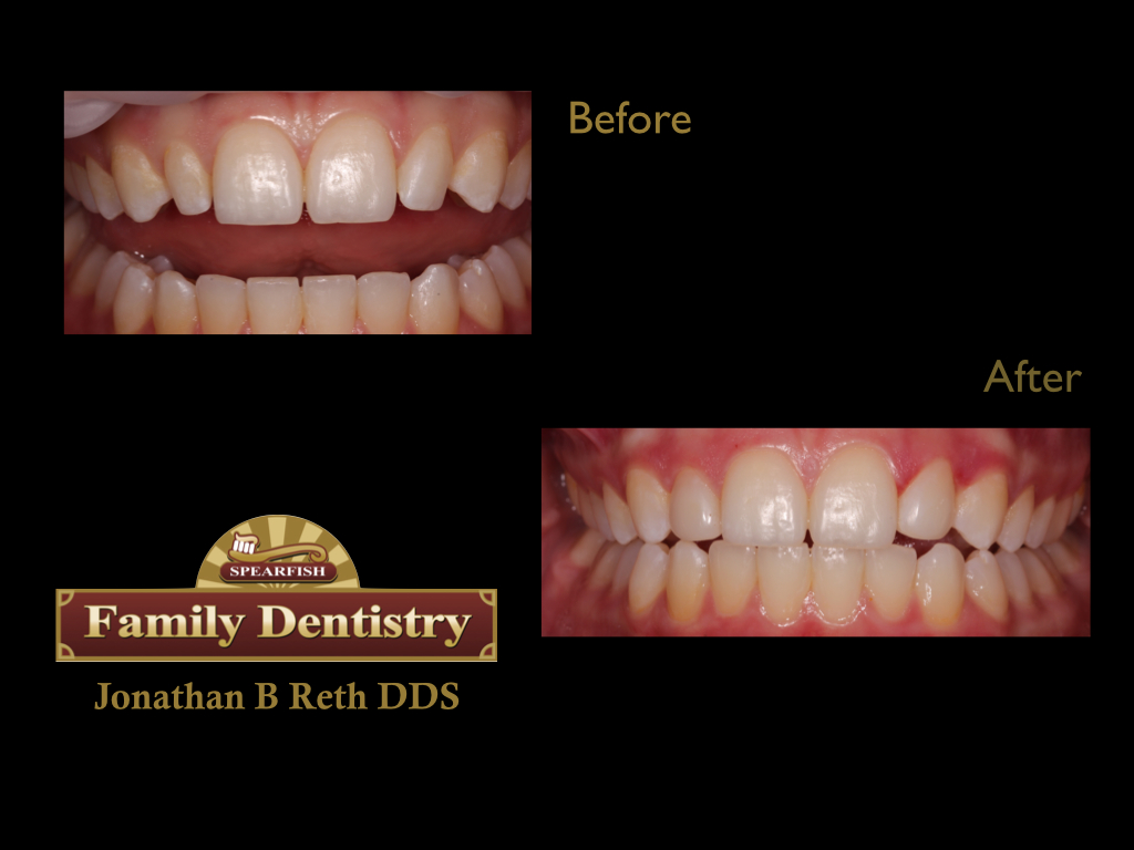 Restoring Peg-Lateral incisors with direct chair side bondings.
