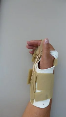 Forearm Based MP Flexion Splint