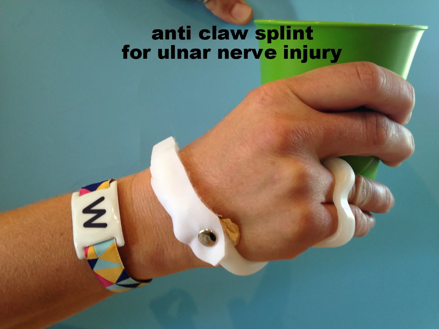 Anti Ulnar Claw Orthoses