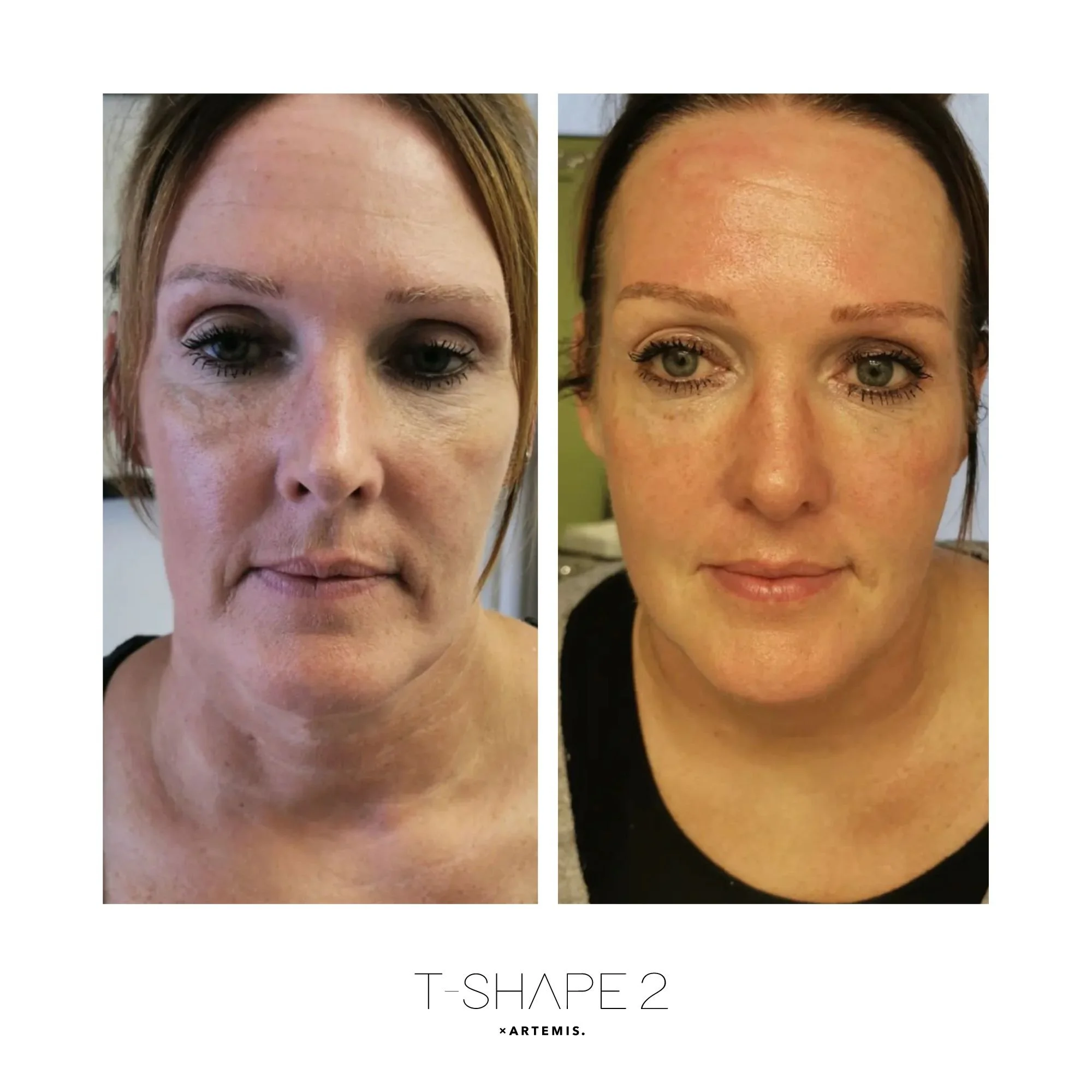 After 4 treatments.jpg