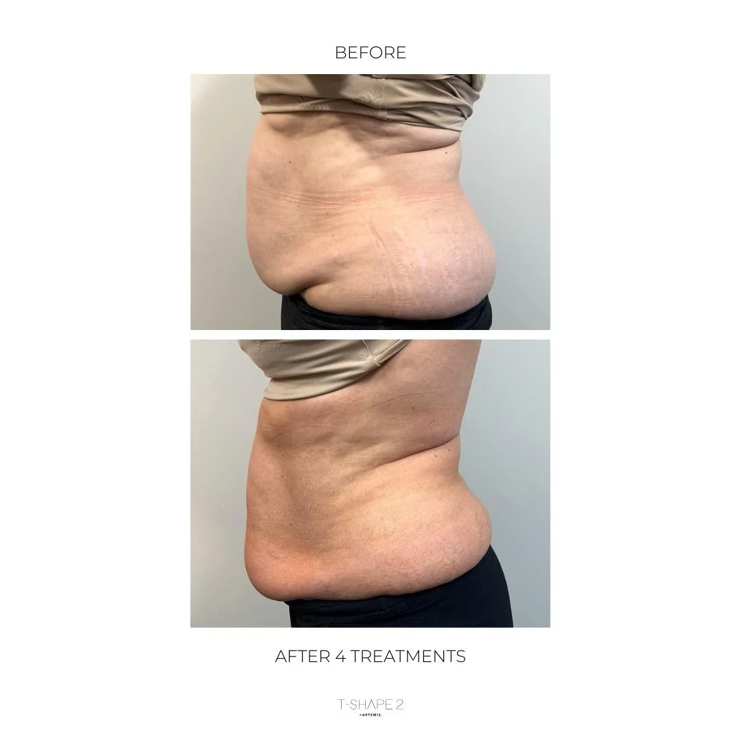 After 4 treatments copy.jpg