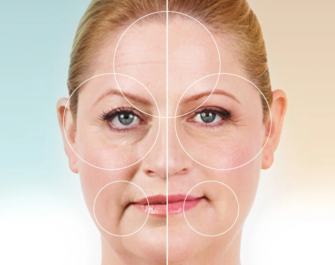 juvederm-Example.jpg