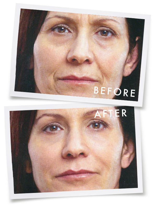 BeforeAfter-Botox.jpg