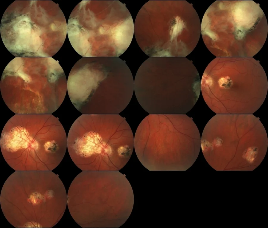 Patrick Anderson's retinal scans