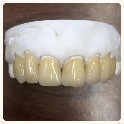 8 Emax Crowns