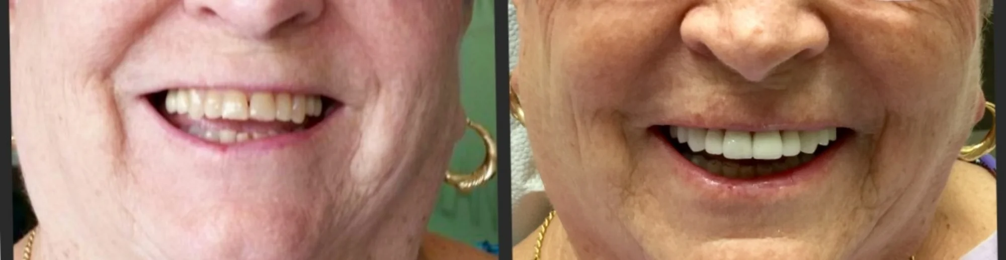 Emax / Zirconia