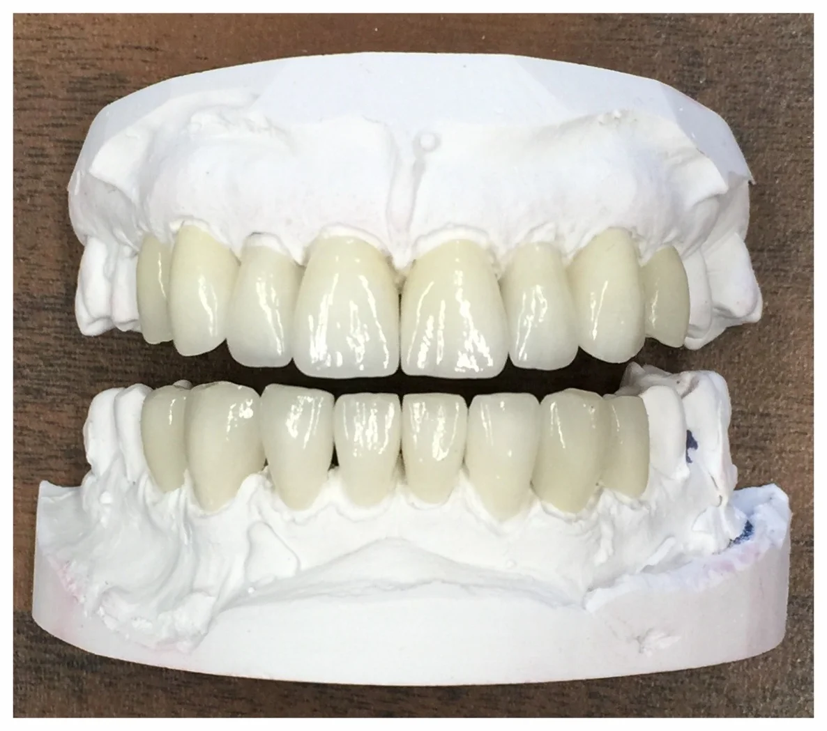 Emax Crowns