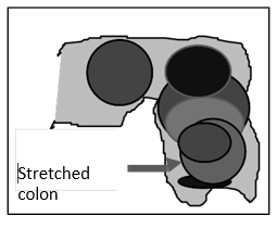 Encopresis_Box_4.png