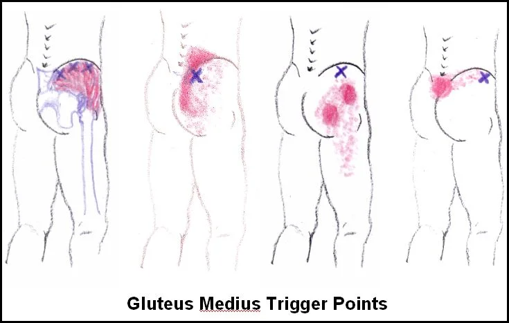 gluteus_medius_trigger_points.jpg