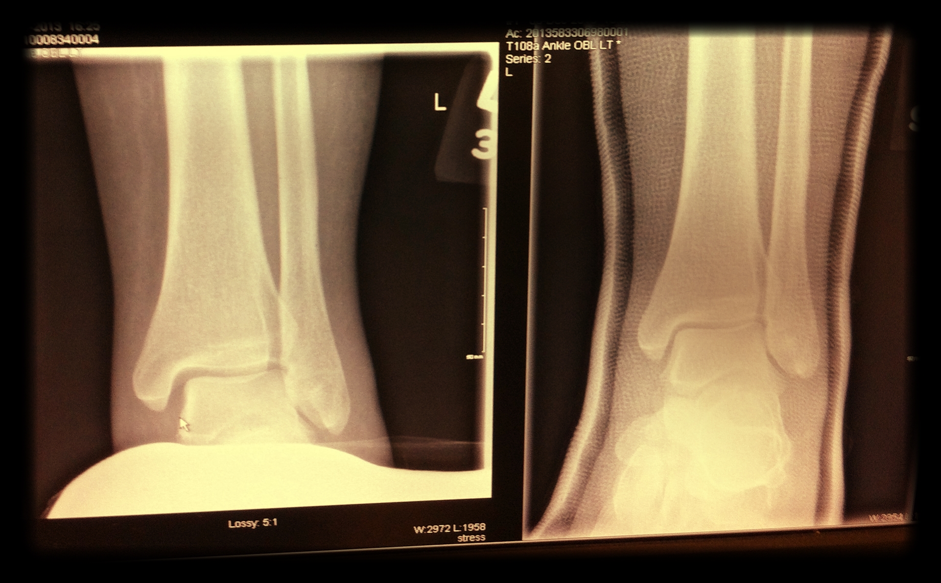My_leg_x-ray