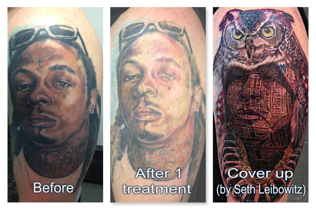 Before & After — Disappearing Ink Laser Tattoo Removal