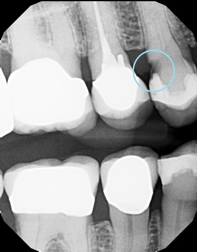  Cavity found using x-ray examination. 