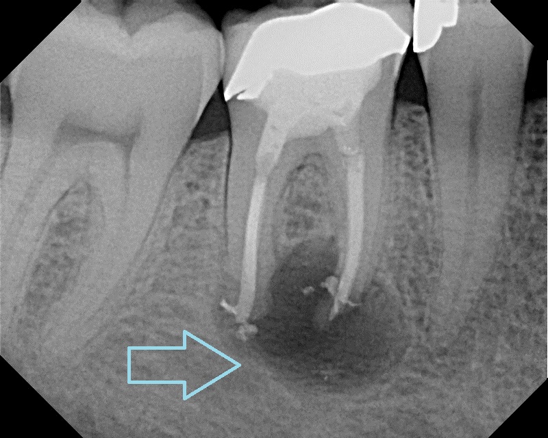 Lakes Region Dental CenterWhy Do I Need X-Rays?Lakes Region Dental Center