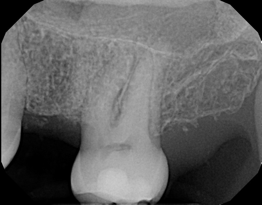  1. Upper left molar missing. 