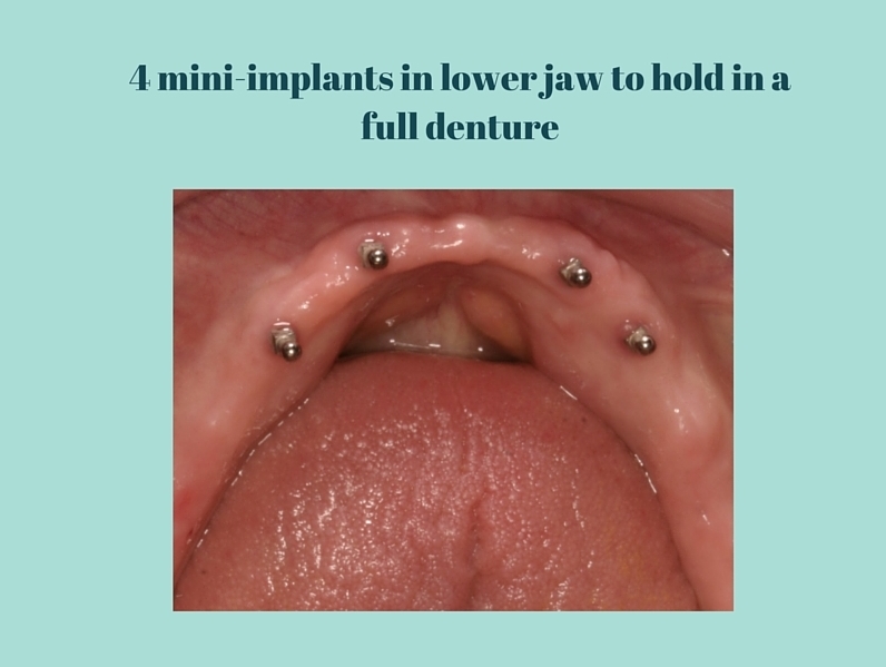 Mini Implants - denture.jpg