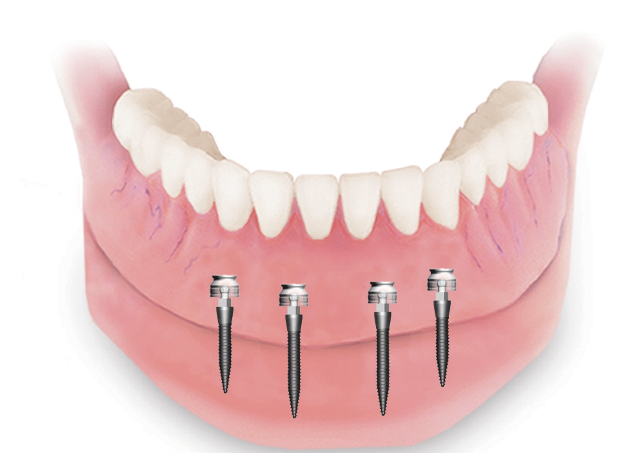  4 mini-implants hold in this lower denture 