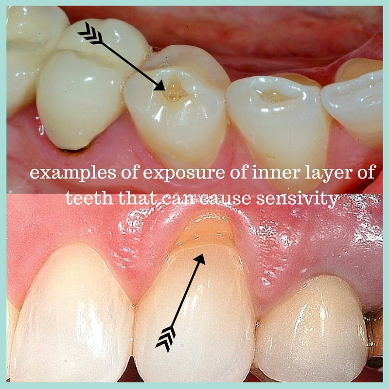 How Do You Know If Your Teeth Are Sensitive Teethwalls