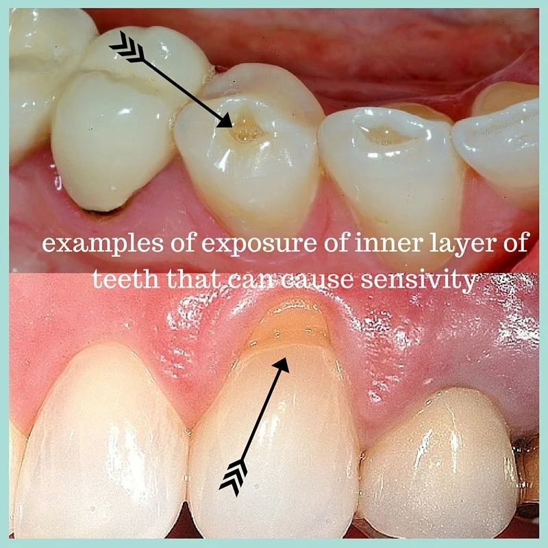 What To Do About Sensitive Teeth — Lakes Region Dental Center