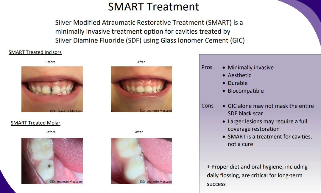 Silver Diamine Fluoride — Lakes Region Dental Center
