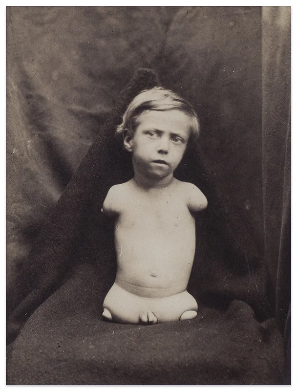 Anonymous - Boy Without Limbs (S).jpg