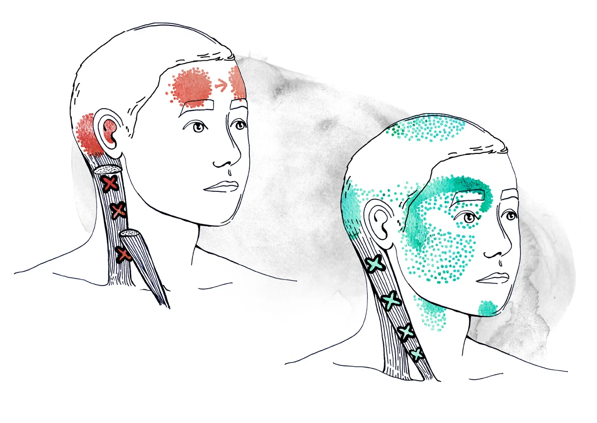 AQ_SM_Masseter_letzte.jpg