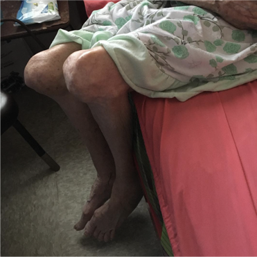  Home visits, like this one to a 90- year old in Lajas, to the most elderly and infirm. Her severe arthritis in arms and legs makes walking impossible 