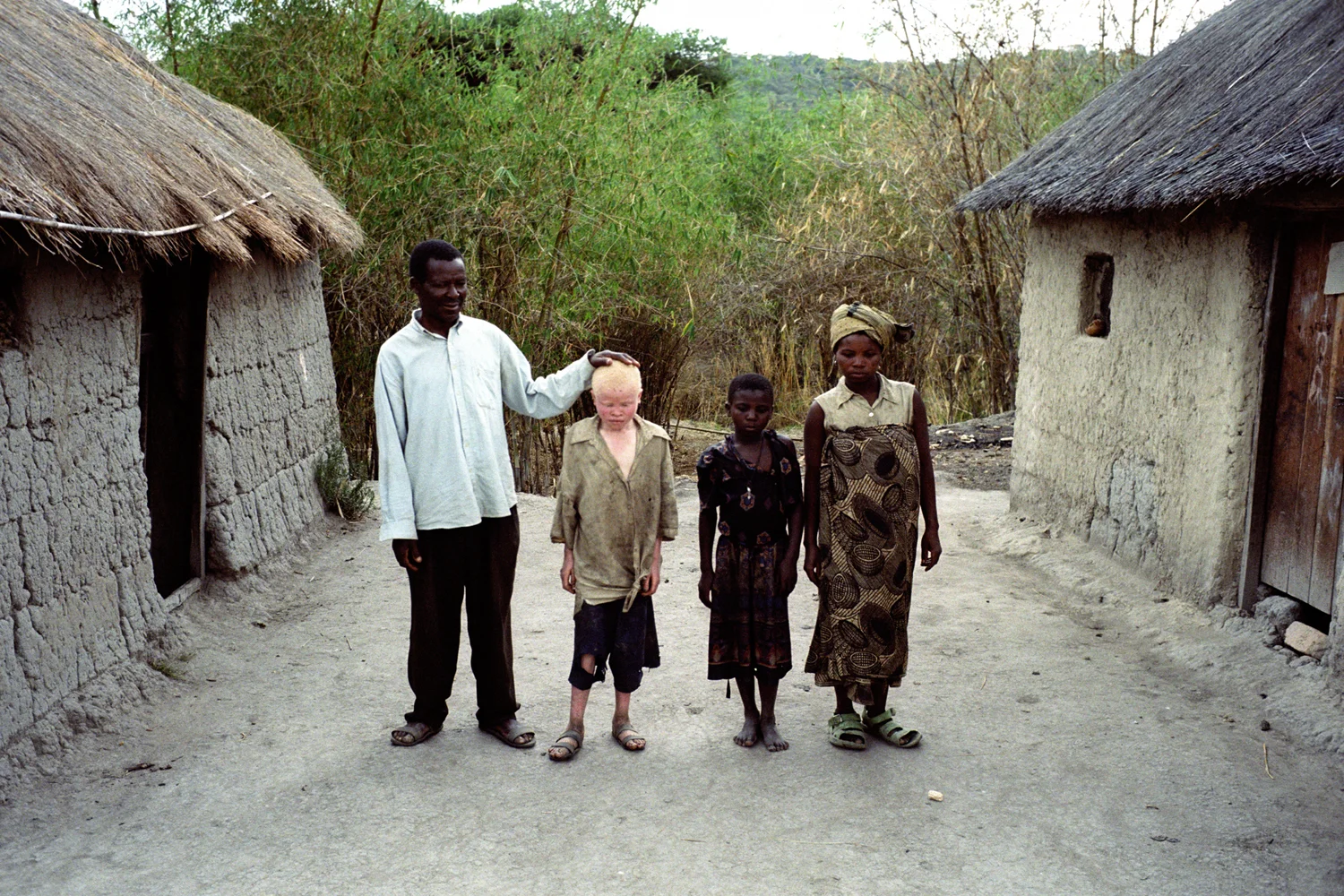 Baraka Mpulule with his parents and sister. Baraka is the first of five children and the only one with albinism. Being from a large and poor farming family means he doesn't get the attention and care he needs and due to his remote location he has never been to see a doctor. Mapogoro Village, Iringa, Tanzania. 