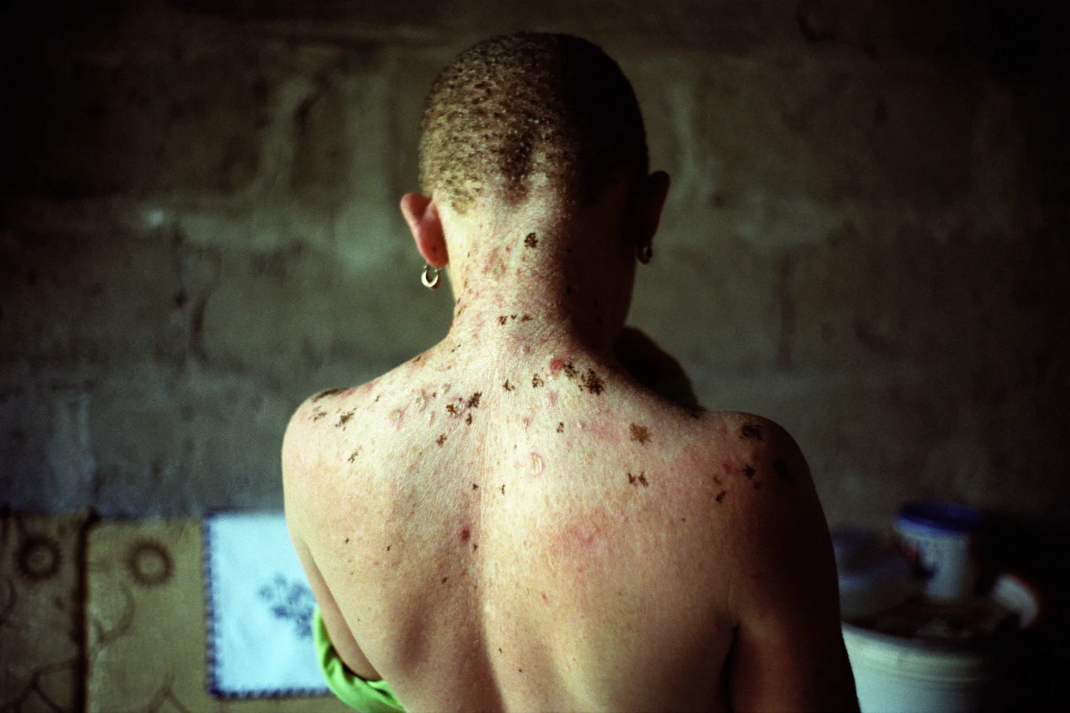 At 19 years old Mwazani Ibrahim already has very badly damaged skin. Preferring to fit in with her friends she doesn't like to cover up in the sun, as its not culturally normal for women in Tanzania to wear hats or long sleeves. Vingunguti, Dar es Salaam, Tanzania.