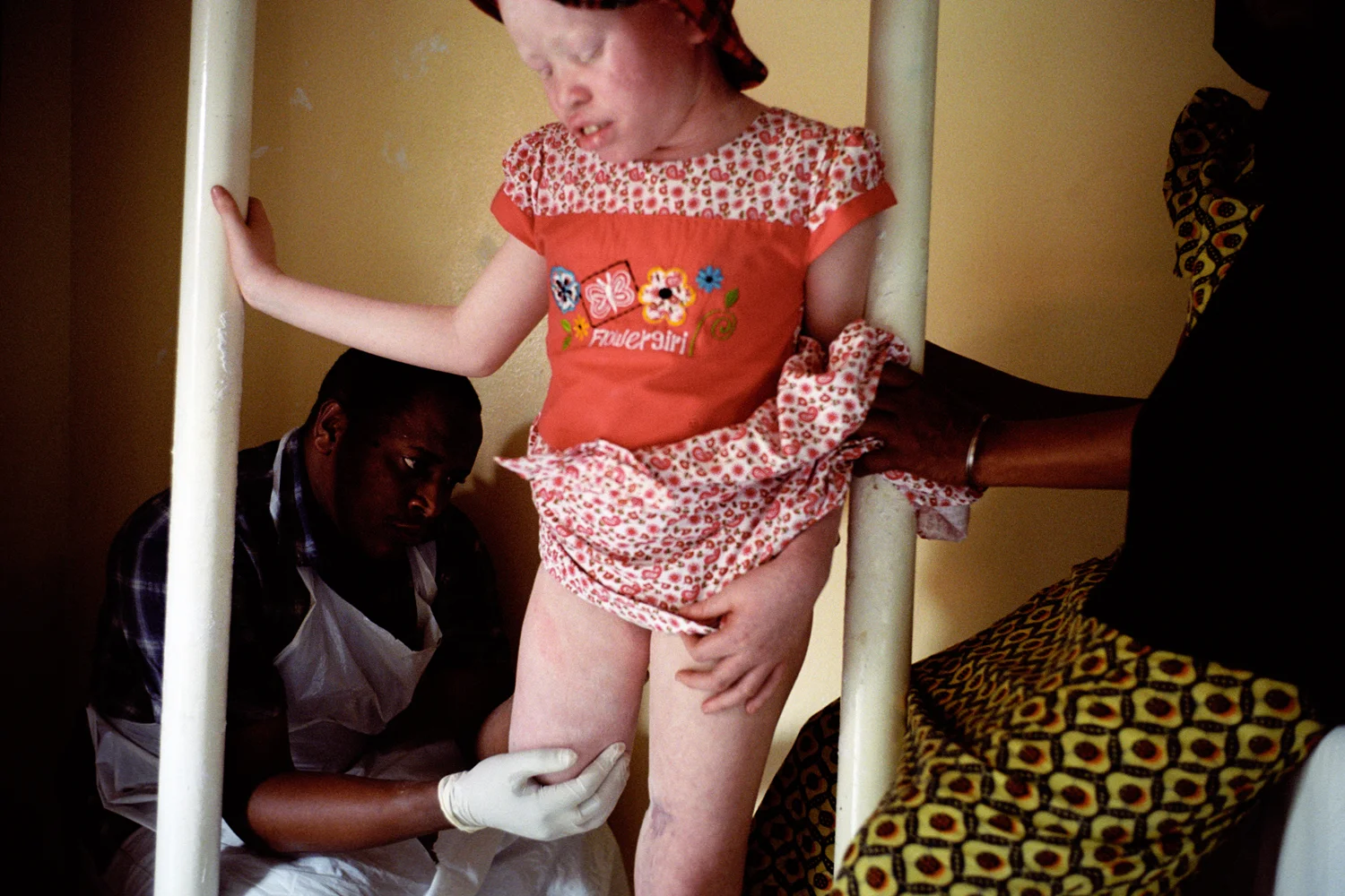 Bibiana Mbushi Mashamba is fitted for a prosthetic leg by Dr Rashidi at the CCBRT hospital. A year ago Bibiana was attacked while she was asleep by men with machetes who had paid off her uncle to let them into the house. Too afraid to go home she stayed in the hospital for a year until Al-Shimaa, a recently appointed MP, was moved to adopting her and her sister Tindi following an official visit to their hospital. Dar es Salaam, Tanzania.