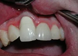 Pre-op picture showing severe recession of the gum. This has the appearance of a "fang."