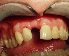Post-op picture following tooth removal and bone grafting of the area at the time of the removal.