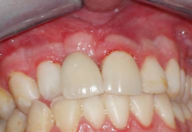 The final replacement tooth held by an implant. Note the excellent and dramatic improvement from the pre-op appearance above.