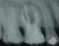Pre-op X-ray Failed Molar Tooth