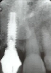 Post-op x-ray showing final crown supported by the implant