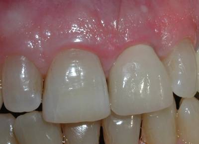 The final clinical appearance of the implant supported crown. Can you tell which is the natural tooth and which is the implant crown?
