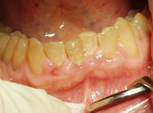 Pre-op picture displaying swollen and infected gum tissues