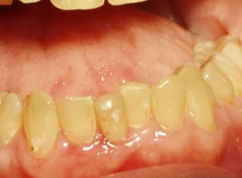 Post-operative picture 2 weeks after laser treatment showing the excellent resolution of the swollenness. The redness of the gum tissues will disappear after several more weeks of healing and will become normal and healthy.