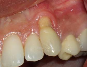 Pre-op picture displaying severe recession of the gum. The patient was very unhappy with the appearance.