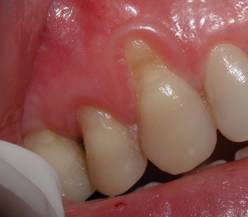 Pre-Op photo showing severe recession of the gum. This had the appearance of a "fang"