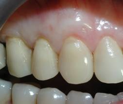 Post-Op picture displaying root coverage of the receded area and significantly improved cosmetics. 