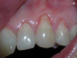 The same patient showing severe Pre-Op recession of the opposite side. 