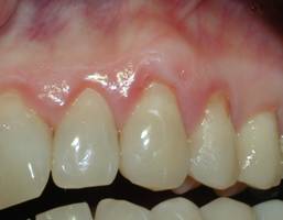 Excellent root overage following the gingival grafting procedure. 