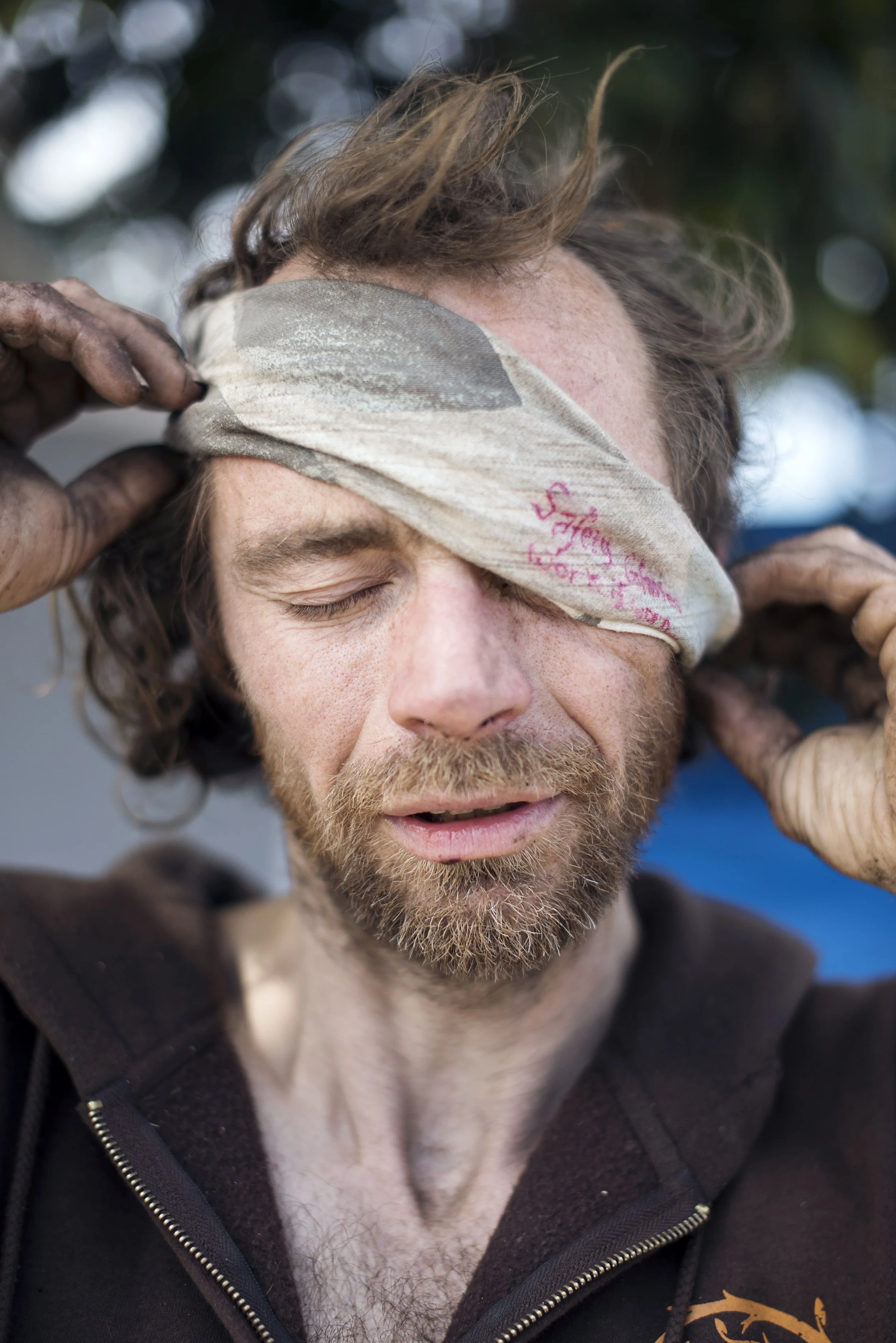  Berkeley, California, USA.  Unhoused man, 40, nurses injured eye 