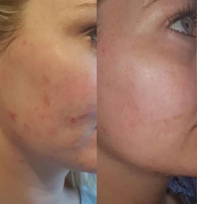 microneedling scars.jpg