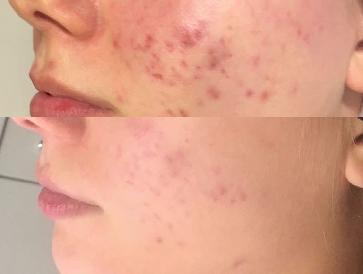 mesopeel mesotech.jpg