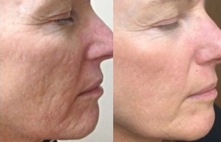 ameson mesothech total skin repair.jpg