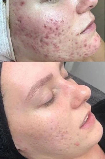 ameson salicyl azelaic dna rna.jpg