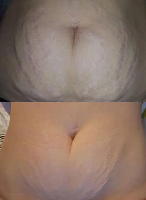 body 6 microneedling sessions.jpg